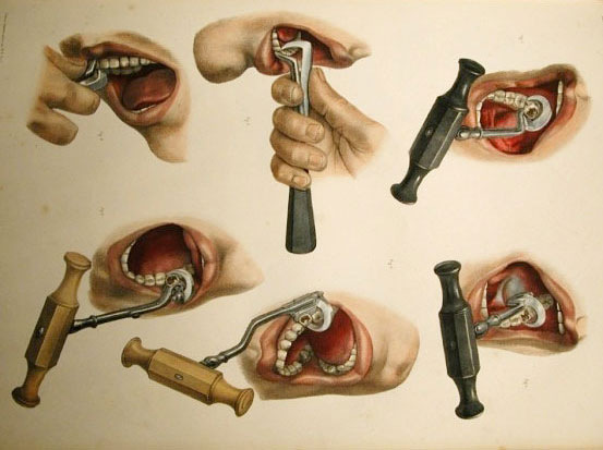 dental-extraction-edited